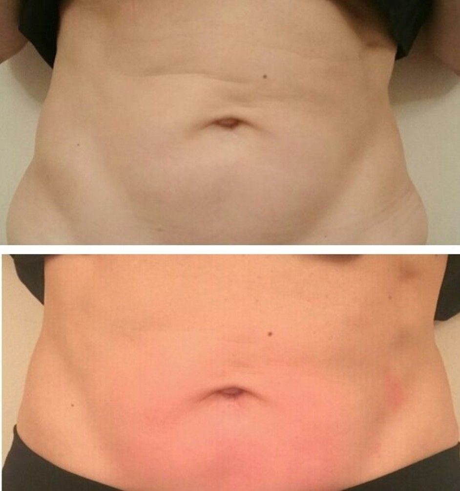 Dermaplaning exfoliation treatment at Unique Boutique in Newton Centre, MA