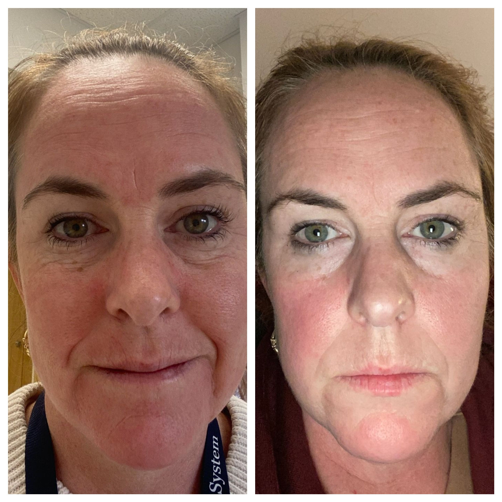 Acne and rosacea skincare treatment at Unique Boutique in Newton Centre, MA