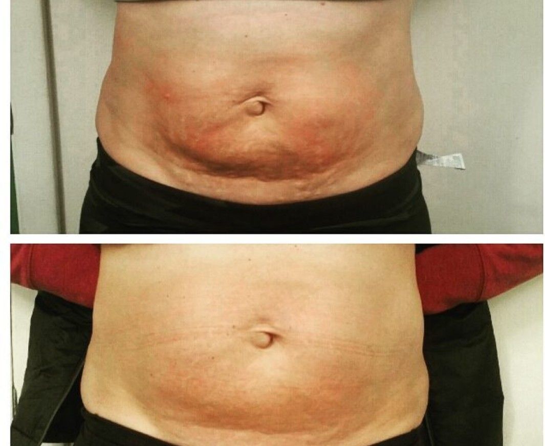 Non-invasive body contouring treatment at Unique Boutique in Newton Centre, MA