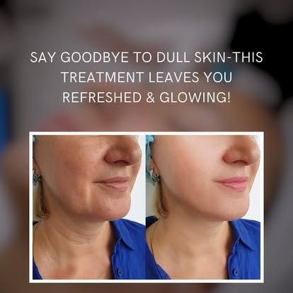 Microcurrent facial lifting treatment at Unique Boutique in Newton Centre, MA